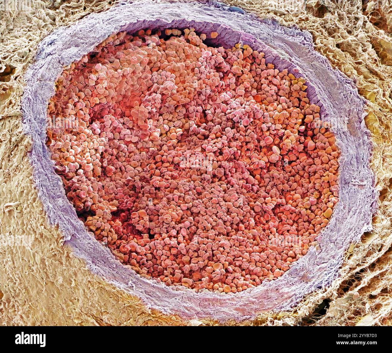 Arteria. Micrografia elettronica a scansione colorata (SEM) di una sezione trasversale attraverso un'arteria muscolare. L'arteria è piena di globuli rossi (eritrociti, rossi) che trasportano ossigeno intorno al corpo. Le pareti dell'arteria sono costituite dalla tunica intima e dalla tunica media muscolare più interna e dalla tunica adventitia fibrosa. Le arterie muscolari si trovano nei rami arteriosi più piccoli. Il muscolo che contengono consente di controllare il volume di sangue che raggiunge il tessuto che forniscono. Ingrandimento: X300 se stampato a 10 centimetri di larghezza. Foto Stock