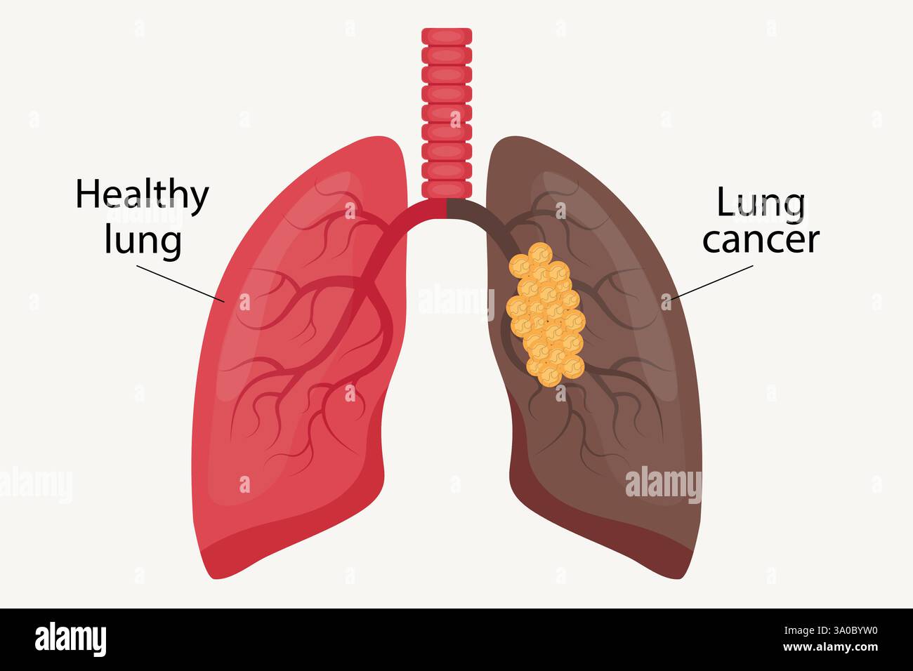 Illustrazione di cancro polmonare e polmonare sano. Illustrazione Vettoriale