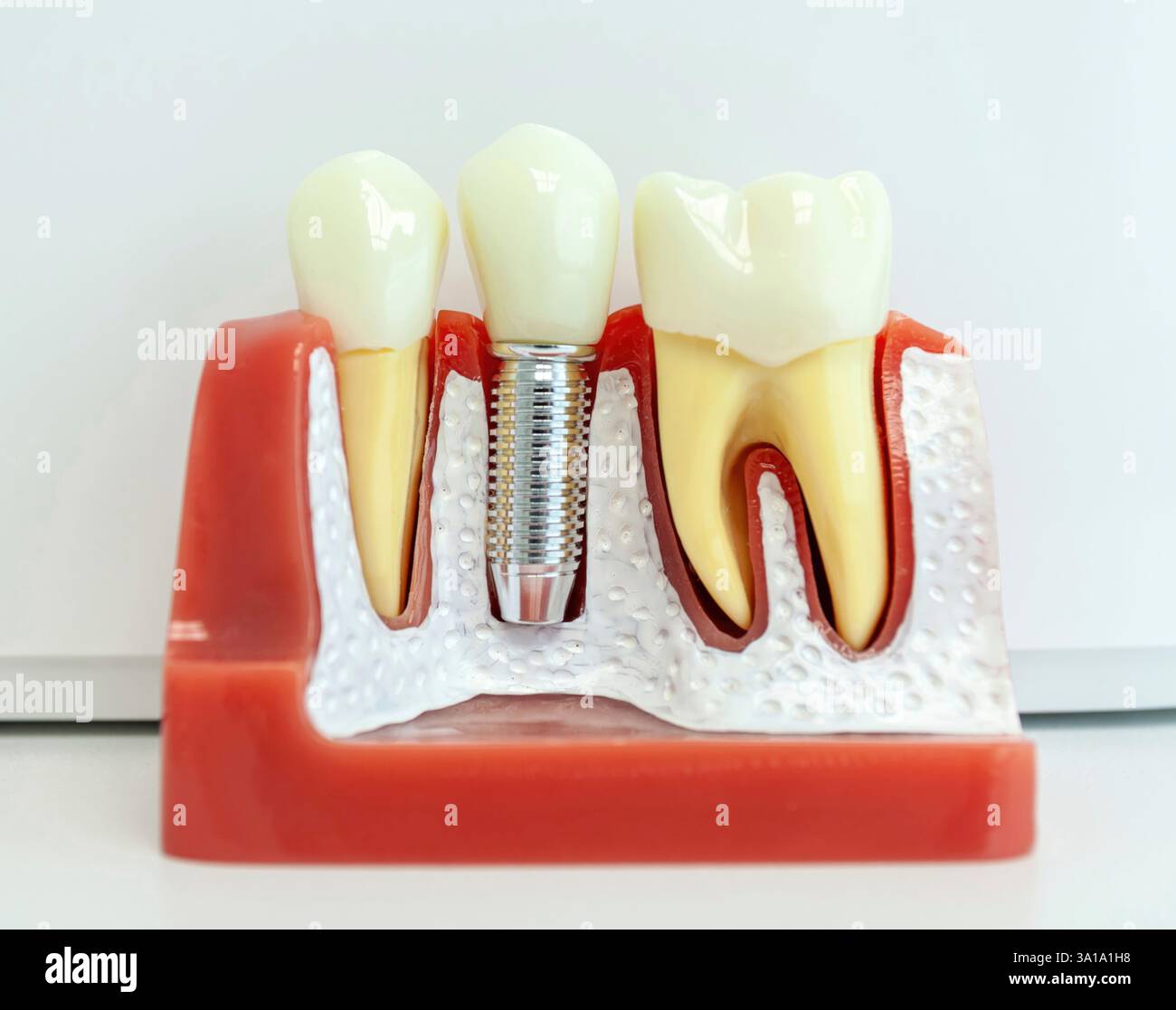 Primo piano di un modello di impianto dentale che dimostra l'integrazione di un impianto nella mascella, evidenziando denti e gengive sani Foto Stock