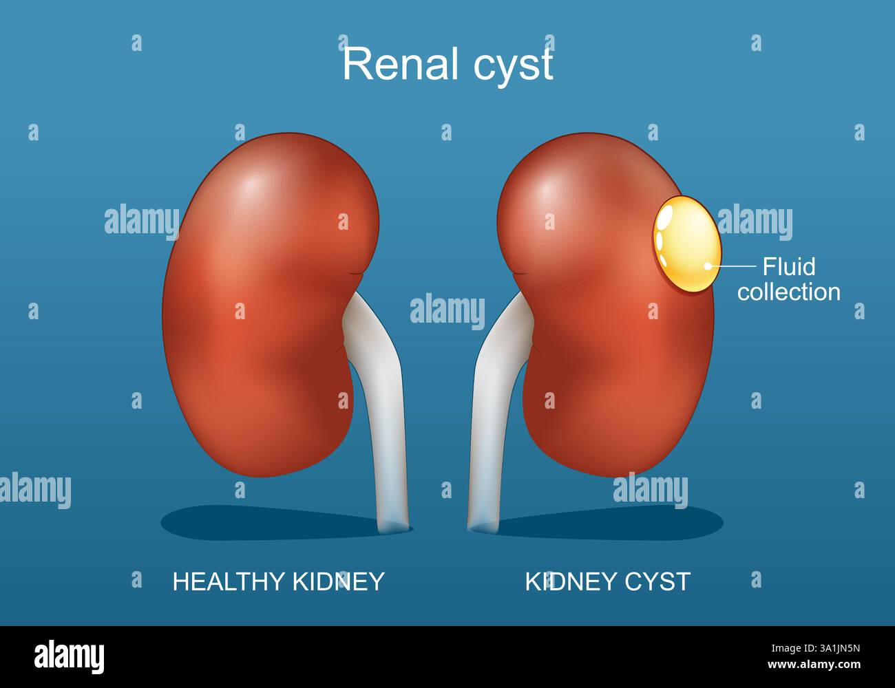 Cisti renale. Normale rene umano e cisti renale. Illustrazione vettoriale. Illustrazione Vettoriale