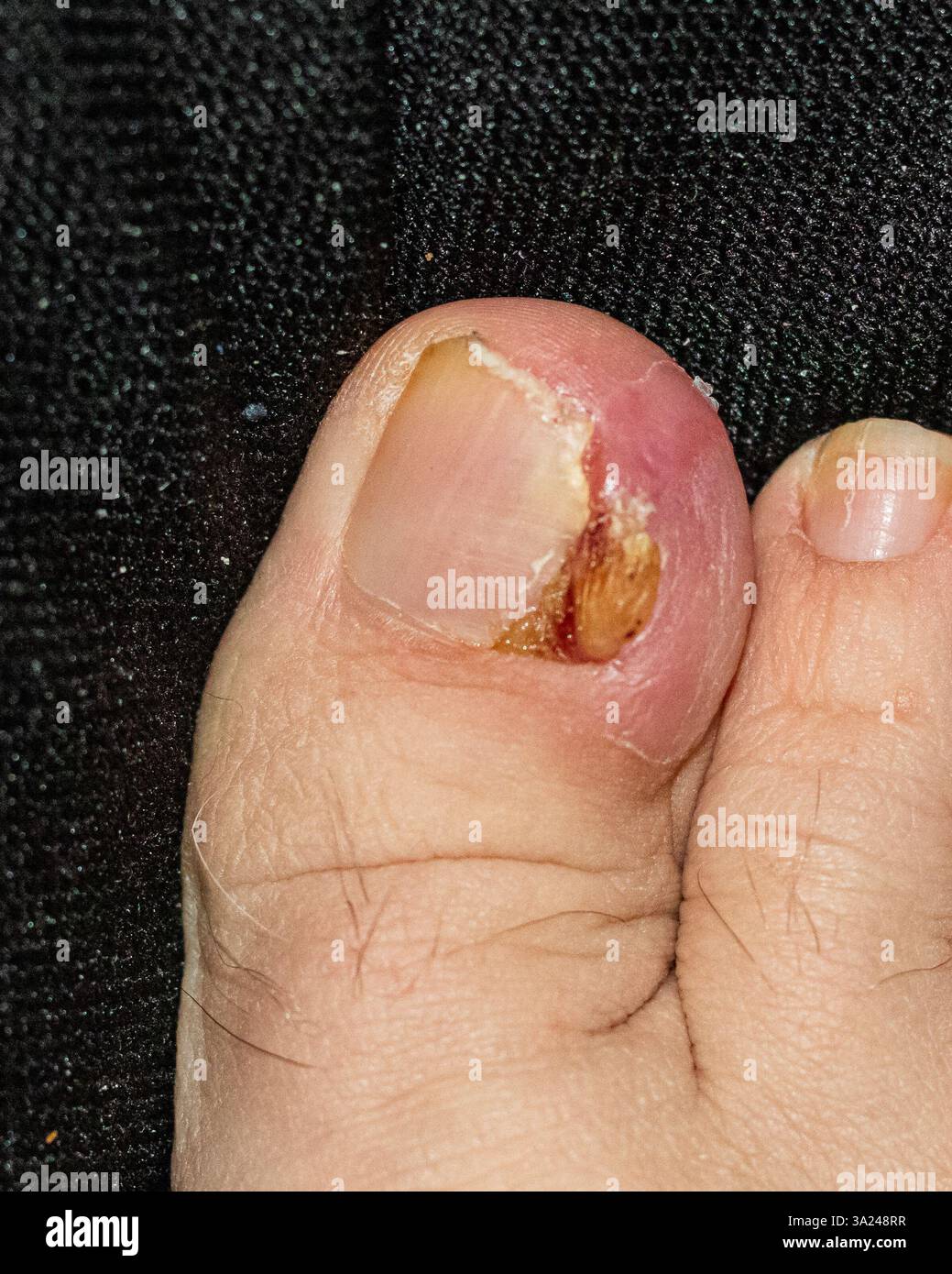 Foto macro dettagliata di un'unghia del piede umano affetta da trauma, che mostra la rugosità e le fasi di guarigione. Utile per studi medici, apprendimento di assistenza sanitaria, Foto Stock