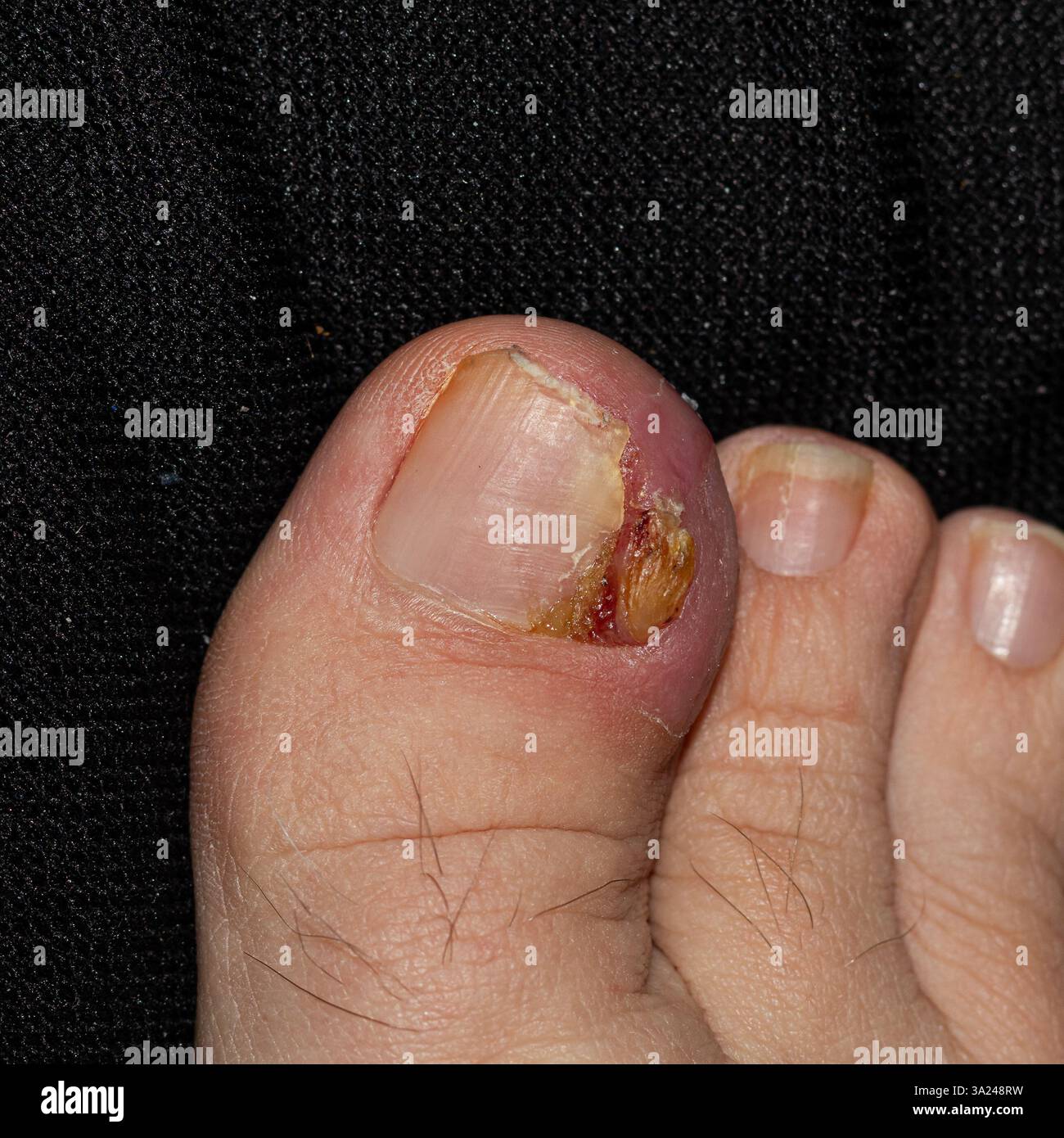 Foto macro dettagliata di un'unghia del piede umano affetta da trauma, che mostra la rugosità e le fasi di guarigione. Utile per studi medici, apprendimento di assistenza sanitaria, Foto Stock