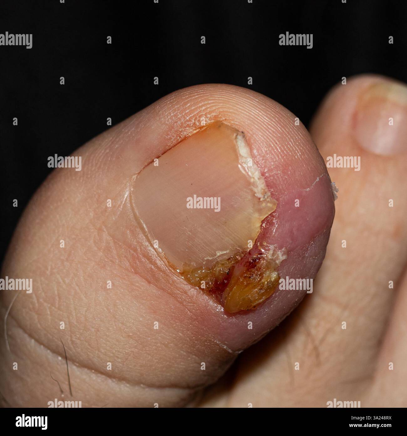 Foto macro dettagliata di un'unghia del piede umano affetta da trauma, che mostra la rugosità e le fasi di guarigione. Utile per studi medici, apprendimento di assistenza sanitaria, Foto Stock