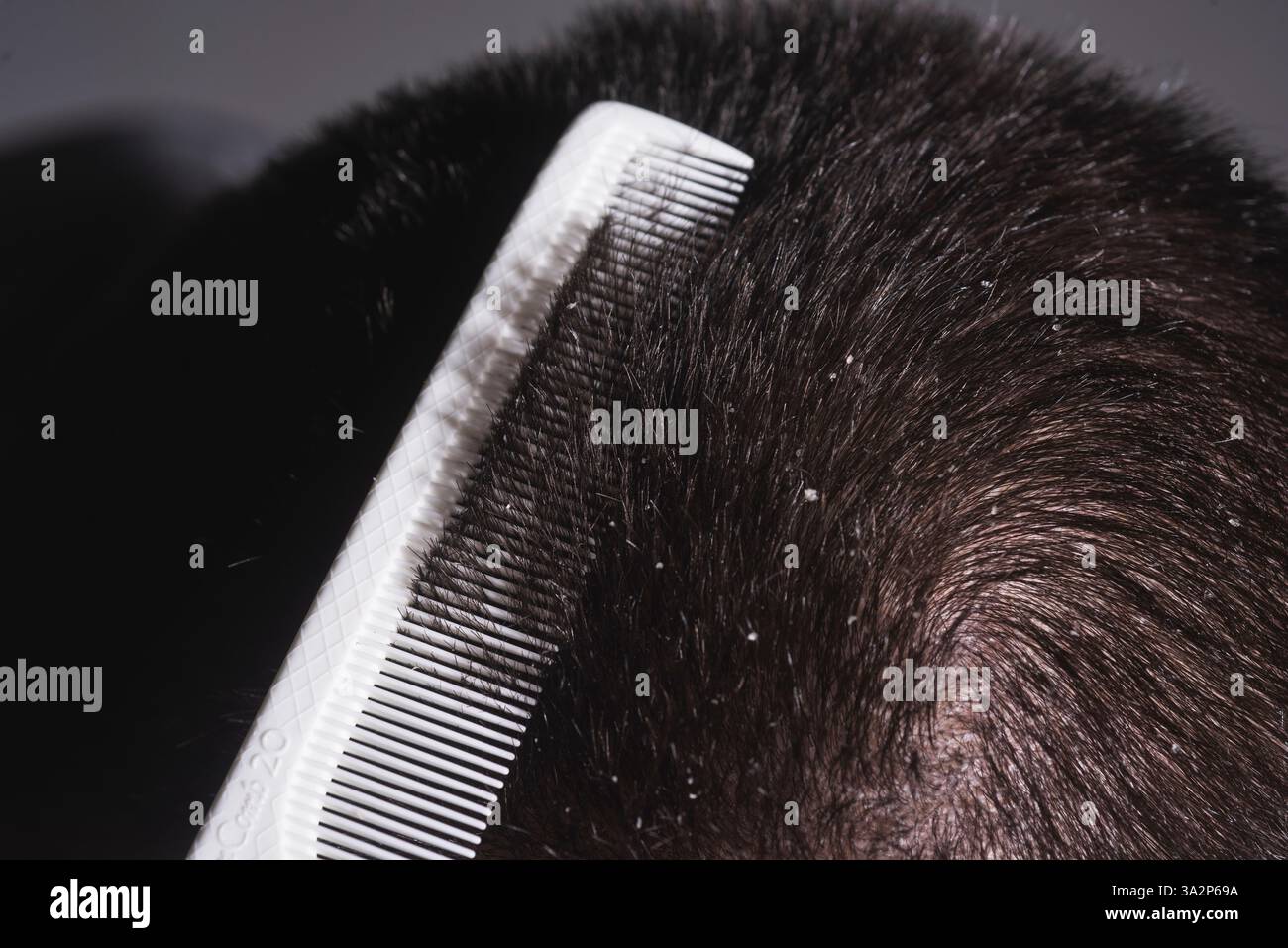 Capelli disordinati. Capelli con forfora. Problema del cuoio capelluto, forfora e dermatite o eczema. Problema di forfora. Malattia dei capelli seborrea. Fatty Dandruff Foto Stock