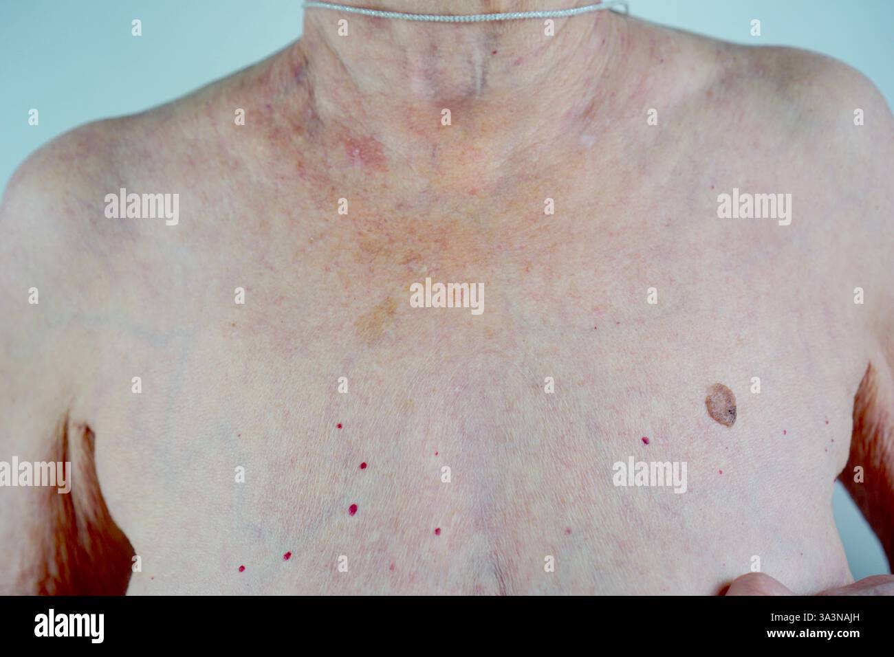 primo piano della parte superiore del corpo di una donna anziana, con particolare attenzione alla pelle invecchiata, con nei multipli, macchie di pigmentazione e segni visibili di invecchiamento. l'immagine sottolinea la salute dermatologica, i potenziali rischi della pelle e l'importanza di controlli medici regolari per la diagnosi precoce delle condizioni della pelle. Foto Stock