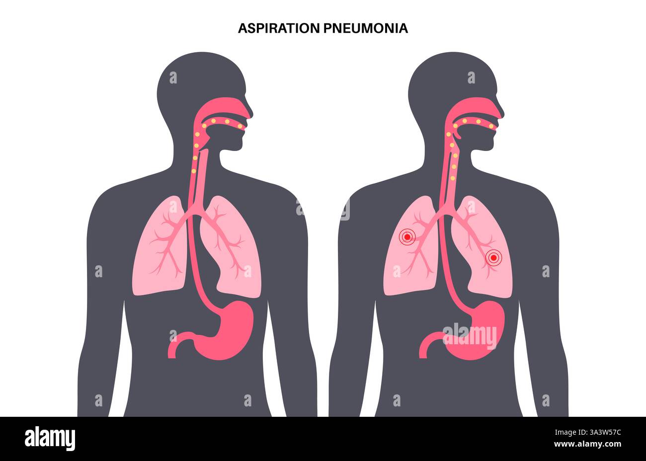 Polmonite da aspirazione, illustrazione. La polmonite da aspirazione è un'infezione polmonare che si verifica quando il materiale contenente batteri dallo stomaco o dalla bocca entra nei polmoni. Questo è più comune nelle persone che hanno difficoltà a deglutire (disfagia), come gli anziani, i giovanissimi, o quelli con disturbi muscolari o del sistema nervoso. I sintomi includono tosse, febbre e respiro corto. Il trattamento e' con gli antibiotici. Foto Stock