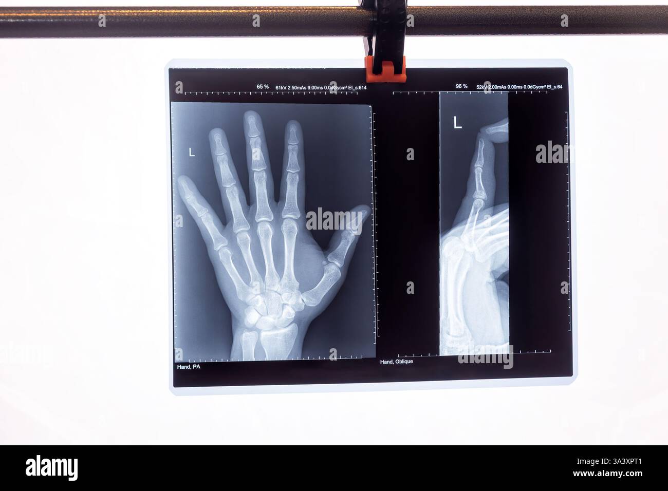 Un'immagine chiara di una pellicola radiografica manuale che mostra sia le viste PA che oblique. La pellicola viene visualizzata utilizzando un morsetto su una barra metallica Foto Stock