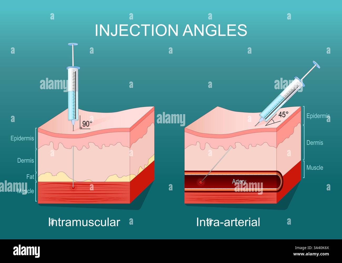 Angoli di iniezione. Sezione trasversale della pelle umana con siringa e ago. Iniezione intra-arteriosa e intramuscolare. Illustrazione vettoriale. Diagra medica Illustrazione Vettoriale