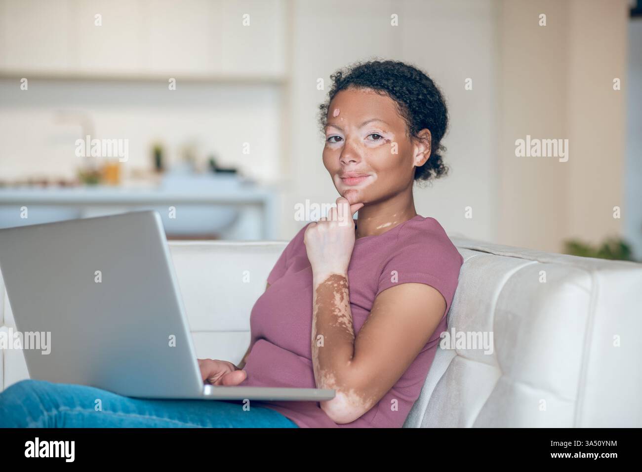 Ritratto di una donna di razza mista con vitiligine a casa, seduta con un laptop sul divano. Una rappresentazione sincera e reale che promuove la positività e il benessere della pelle, perfetta per lo stile di vita e le comunicazioni sulla salute. Foto Stock