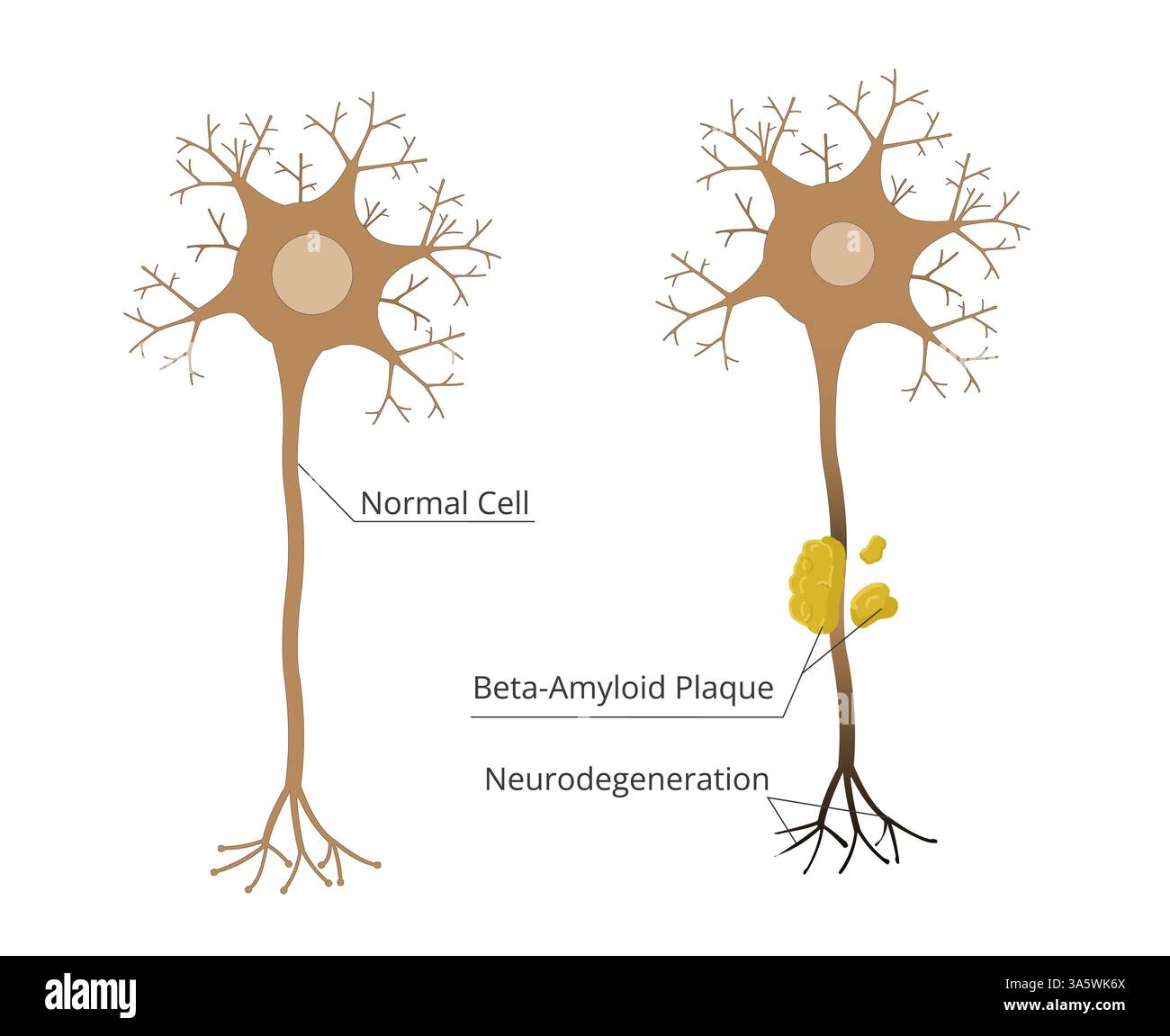 Cellule normali vs neuroni influenzate da neurodegenerazione. Patofisiologia della malattia di Alzheimer, con placche amiloidi che danneggiano le cellule neurali Foto Stock