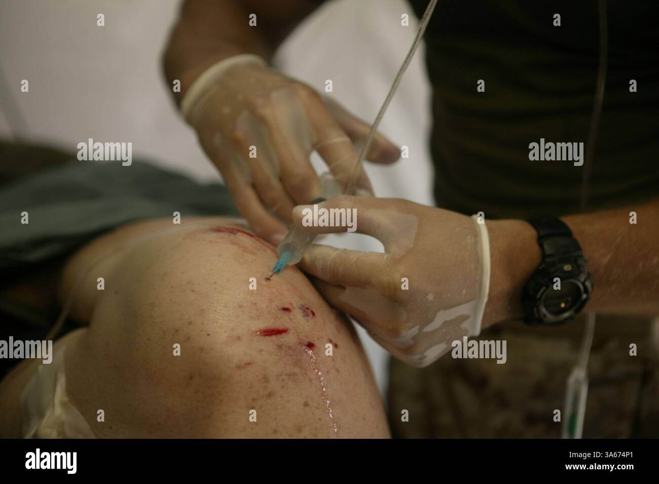 09 settembre 2004; Camp Taqaddum, Iraq; Un tecnico di pronto soccorso della Marina del 1st Force Service Support Group's Surgical/shock Trauma Platoon amministra un anestetico locale su un soldato ferito ferito ferito da schegge durante un'esercitazione di massa, 9 settembre 2004, a Camp Taqaddum, Iraq. Durante l'esercizio, l'unità medica ha inaspettatamente ricevuto tre pazienti vivi - due membri del servizio e un iracheno. Ciò ha fornito all'equipaggio in arrivo l'opportunità di applicare le proprie capacità salvavita in uno scenario reale. Il plotone fornisce cure mediche immediate e salvavita per i pazienti - amichevoli e altri Foto Stock