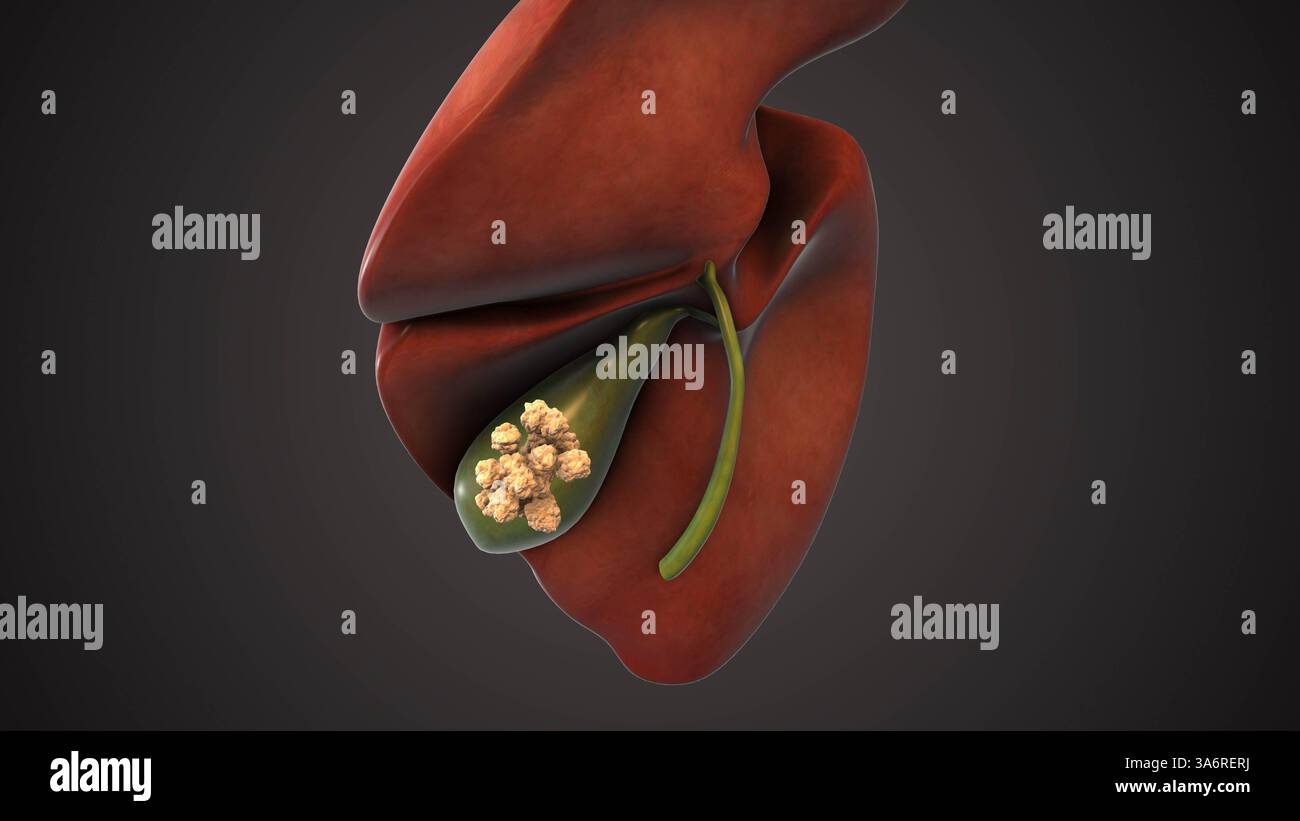 Animazione medica di calcoli della cistifellea Foto Stock