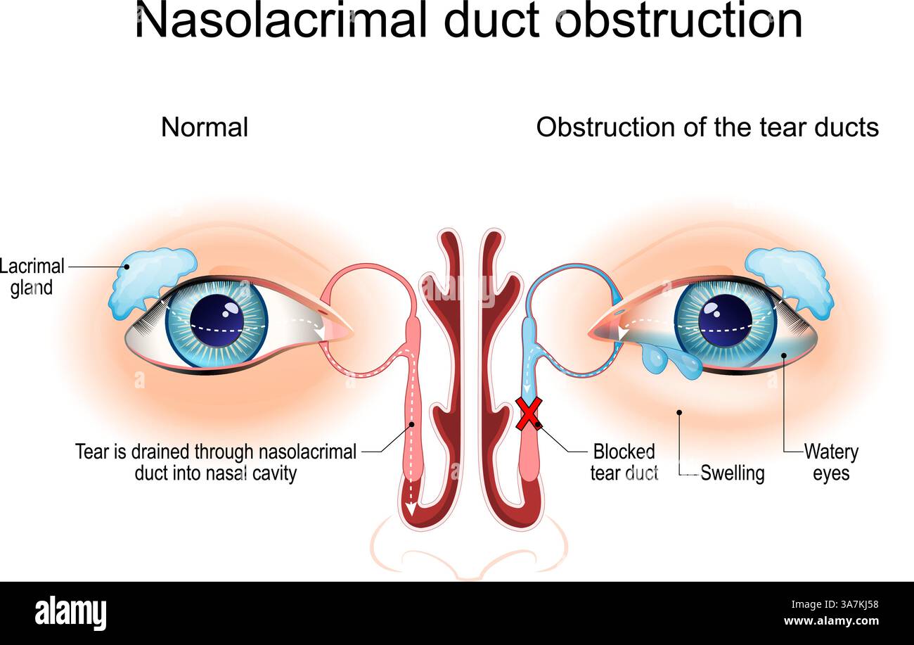 Ostruzione del dotto nasolacrimale. Dacriocistite. Sezione trasversale dei condotti a strappo. Anatomia dell'occhio umano. epifora. Diagramma medico. Illustrazione vettoriale Illustrazione Vettoriale