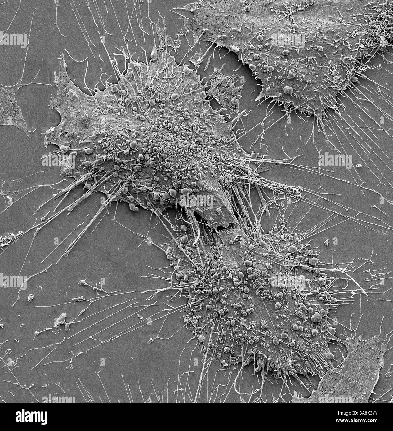 Cellule tumorali ossee. Micrografia elettronica a scansione in bianco e nero delle cellule tumorali dell'osteosarcoma. L'osteosarcoma è un tumore maligno aggressivo derivante da cellule mesenchimali trasformate primitive. È la forma istologica più comune di cancro osseo primario. La maggior parte delle persone con osteosarcoma ha meno di 25 anni, e si pensa che si verifichi più spesso nei maschi che nelle femmine. L'osteosarcoma è spesso trattato con una combinazione di terapie che possono includere chirurgia, chemioterapia e radioterapia. Ingrandimento: X1500 se stampato a 10 centimetri di larghezza. Foto Stock