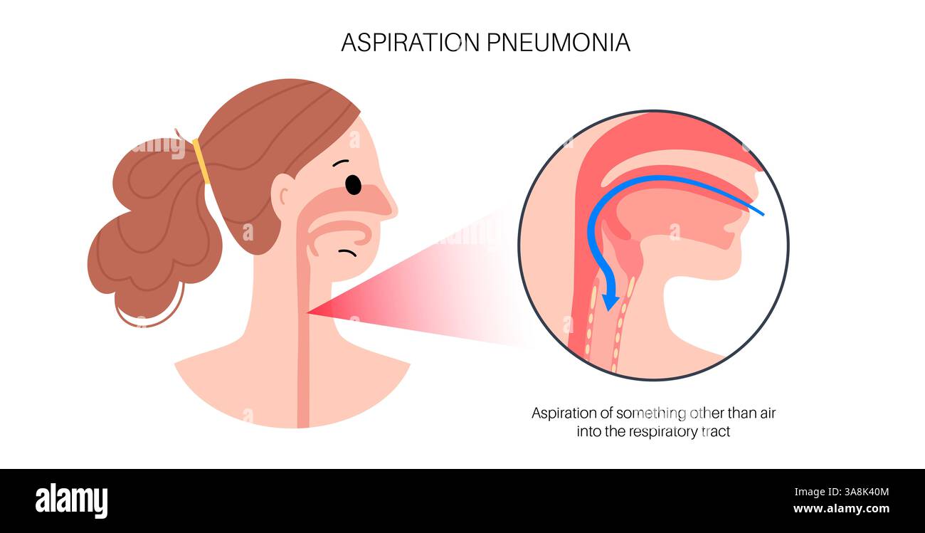 Polmonite da aspirazione, illustrazione. La polmonite da aspirazione è un'infezione polmonare che si verifica quando il materiale contenente batteri dallo stomaco o dalla bocca entra nei polmoni. Questo è più comune nelle persone che hanno difficoltà a deglutire (disfagia), come gli anziani, i giovanissimi, o quelli con disturbi muscolari o del sistema nervoso. I sintomi includono tosse, febbre e respiro corto. Il trattamento e' con gli antibiotici. Foto Stock