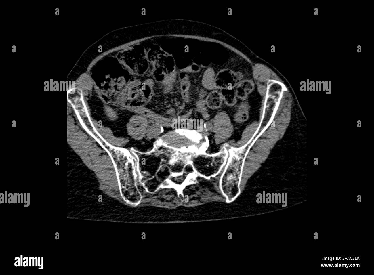 Tomografia computerizzata di una nonna dopo una caduta con osteoporosi e fratture da compressione delle vertebre Th9-Th12, nonché intervento chirurgico sulla L1- Foto Stock