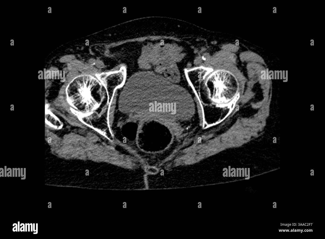Tomografia computerizzata di una nonna dopo una caduta con osteoporosi e fratture da compressione delle vertebre Th9-Th12, nonché intervento chirurgico sulla L1- Foto Stock