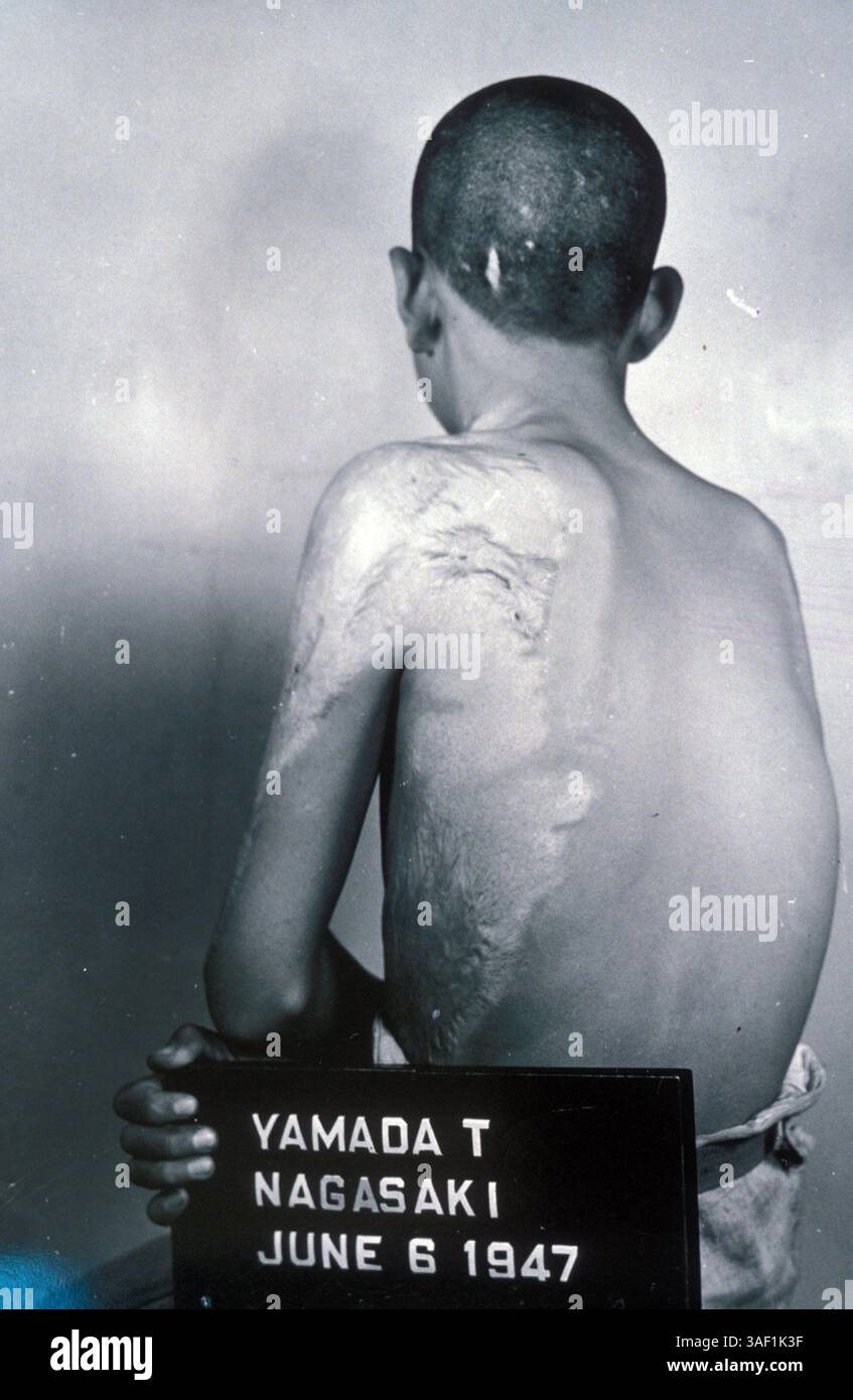 05 lug 2005; Nagasaki, Giappone; foto file, data sconosciuta. La schiena di una donna vittima di avvelenamento da radiazioni a causa dell'attentato di Nagasaki. Credito obbligatorio: Foto di ZUMA Archive/ZUMA Press. (©) Copyright 2005 di ZUMA Archive Foto Stock