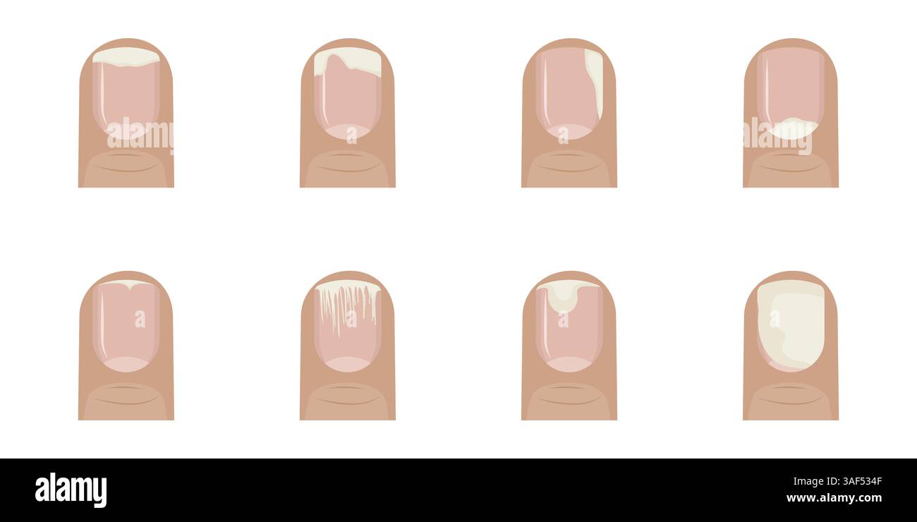 Sono raffigurati modelli di onicolisi, che mostrano vari stadi e forme di separazione delle unghie dal letto delle unghie, fornendo una guida visiva per l'identificazione del nai Illustrazione Vettoriale