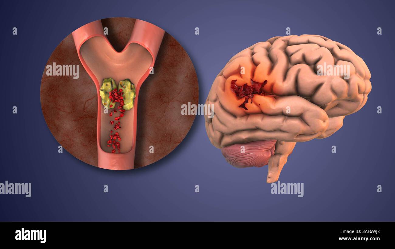 Terapia ricombinante per la rimozione dei coaguli di sangue Foto Stock