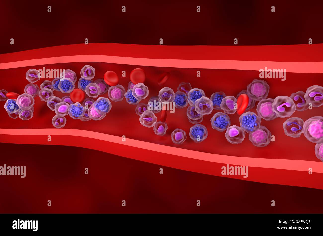 Linfoma diffuso a grandi cellule B (DLBCL) - Vista isometrica illustrazione 3d. Foto Stock
