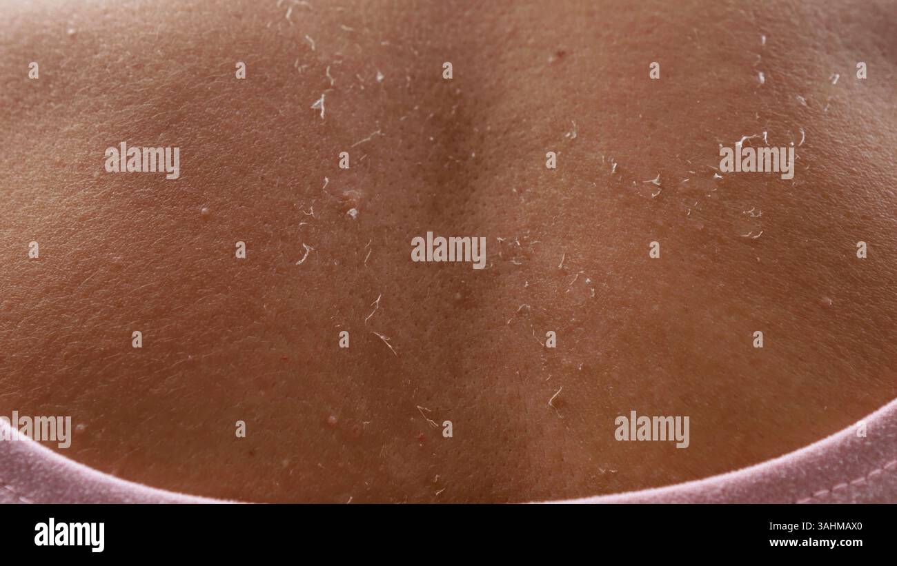 Peeling cutaneo scottato al sole che mostra un processo di guarigione dopo le vacanze Foto Stock