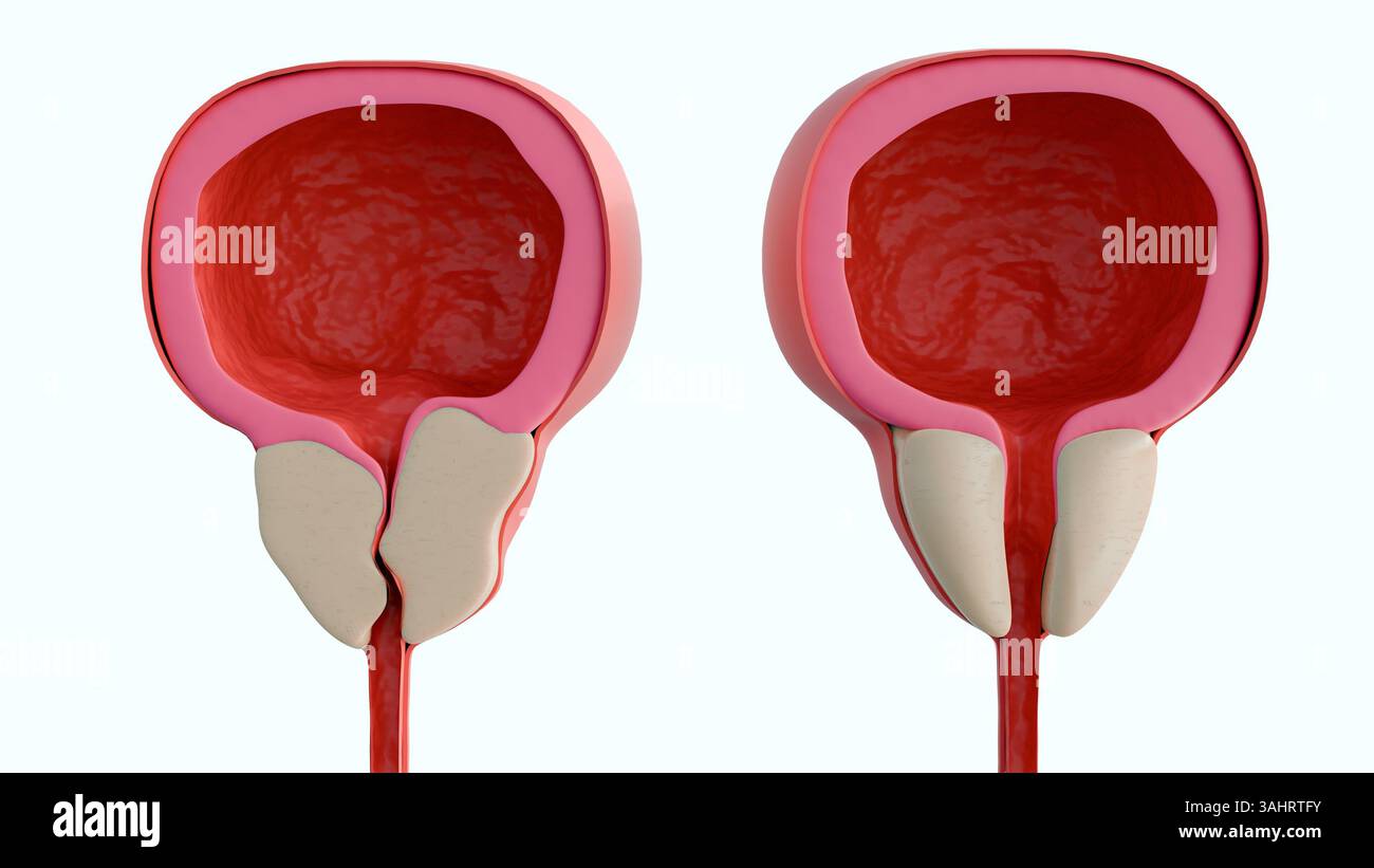 il rendering 3d di due sezioni trasversali sagittali del tratto urinario inferiore sulla sinistra è una ghiandola prostatica ipertrofica, la destra è una prostata normale Foto Stock