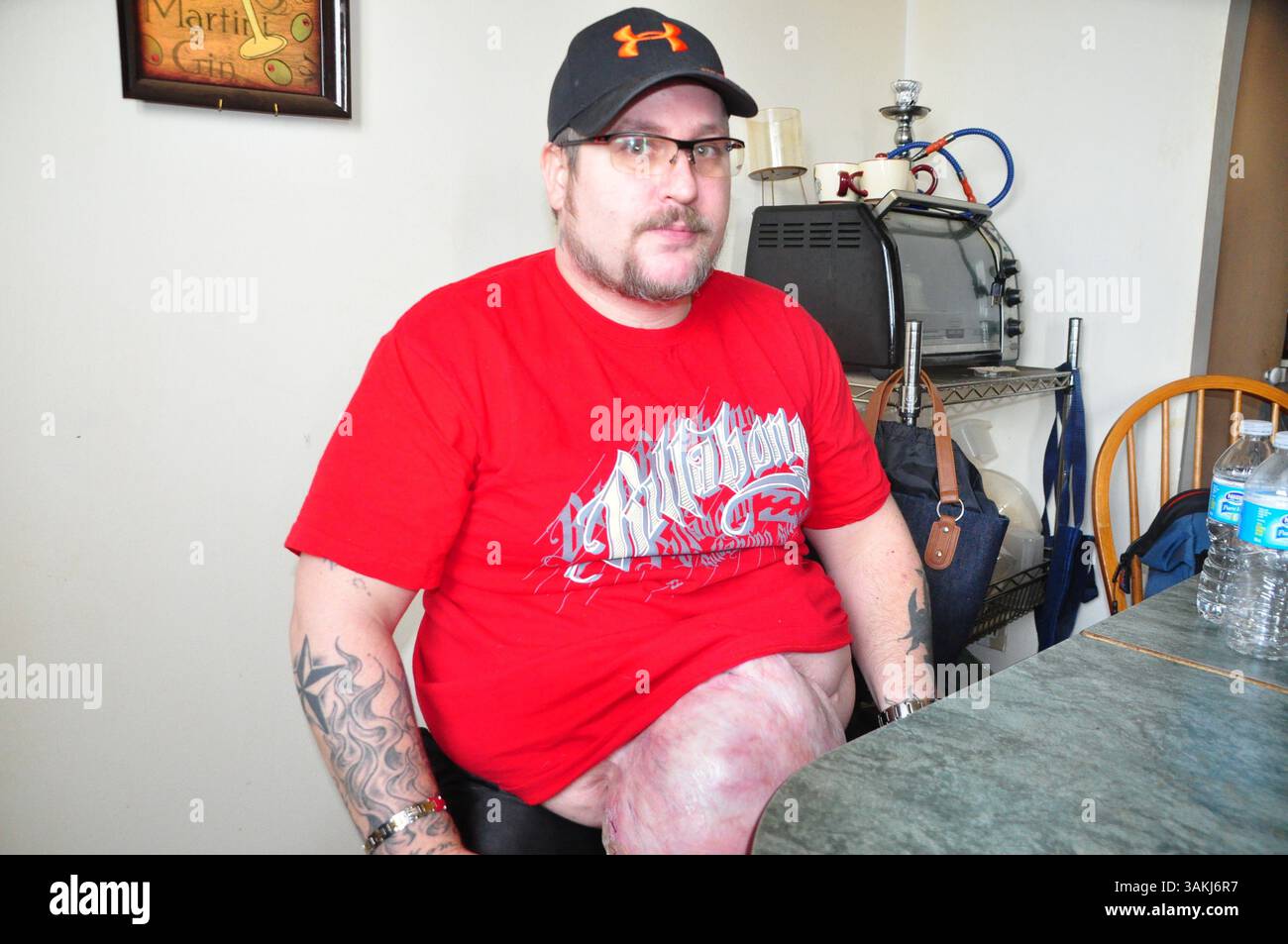 29 novembre 2013 - Repentigny, QC, Canada - EN 2003, le Repentignois Yves Rivest a subi un grave accident de travail qui le plonge dans un coma artificiel pendant trois semaines. ÌÄ? la suite Dì¢??une greffe de peau qui a mal tournÌÄå©, Lì¢??homme de 36 ans doit vivre aujourdÌ¢??hui avec une ÌÄå©norme hernie de 71 centimÌÄå¬tres (28 pouces) sur le ventre alors que les mÌÄå©decins refusent de Lì¢??opÌÄå©rer. DÌÄå©cembre 2013..MARIE-CLAUDE CHIASSON/l'ÌÄ? CHO DE REPENTIGNY/AGENCE QMI (immagine di credito: © Marie-Claude Chiasson/QMI Agency/ZUMAPRESS.com) Foto Stock