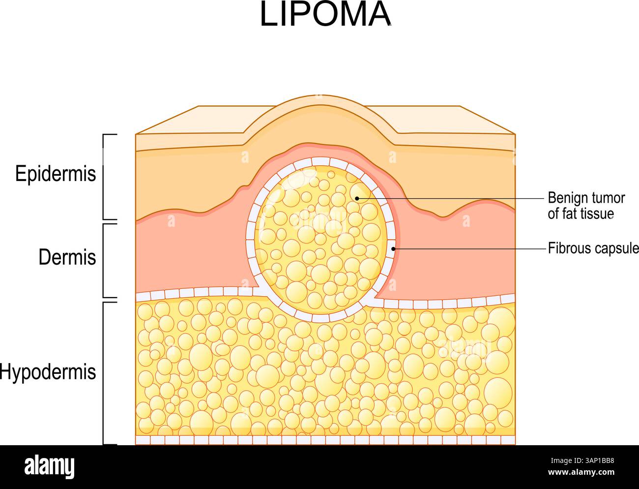 Lipoma. Sezione trasversale di una pelle umana con grumi. Tumore benigno del tessuto adiposo in capsula fibrosa. Tumore adiposo. Illustrazione vettoriale. Medico Illustrazione Vettoriale