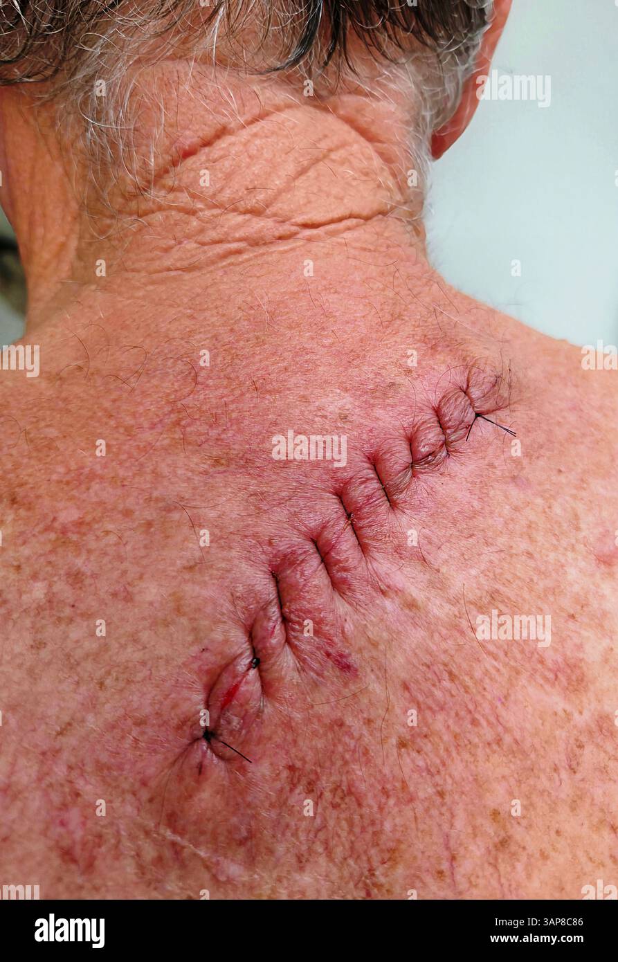 Questa immagine ravvicinata mostra una nuova cicatrice chirurgica, la rimozione del melanoma sulla schiena di un uomo, evidenziando il processo di guarigione e il viaggio verso di essa Foto Stock