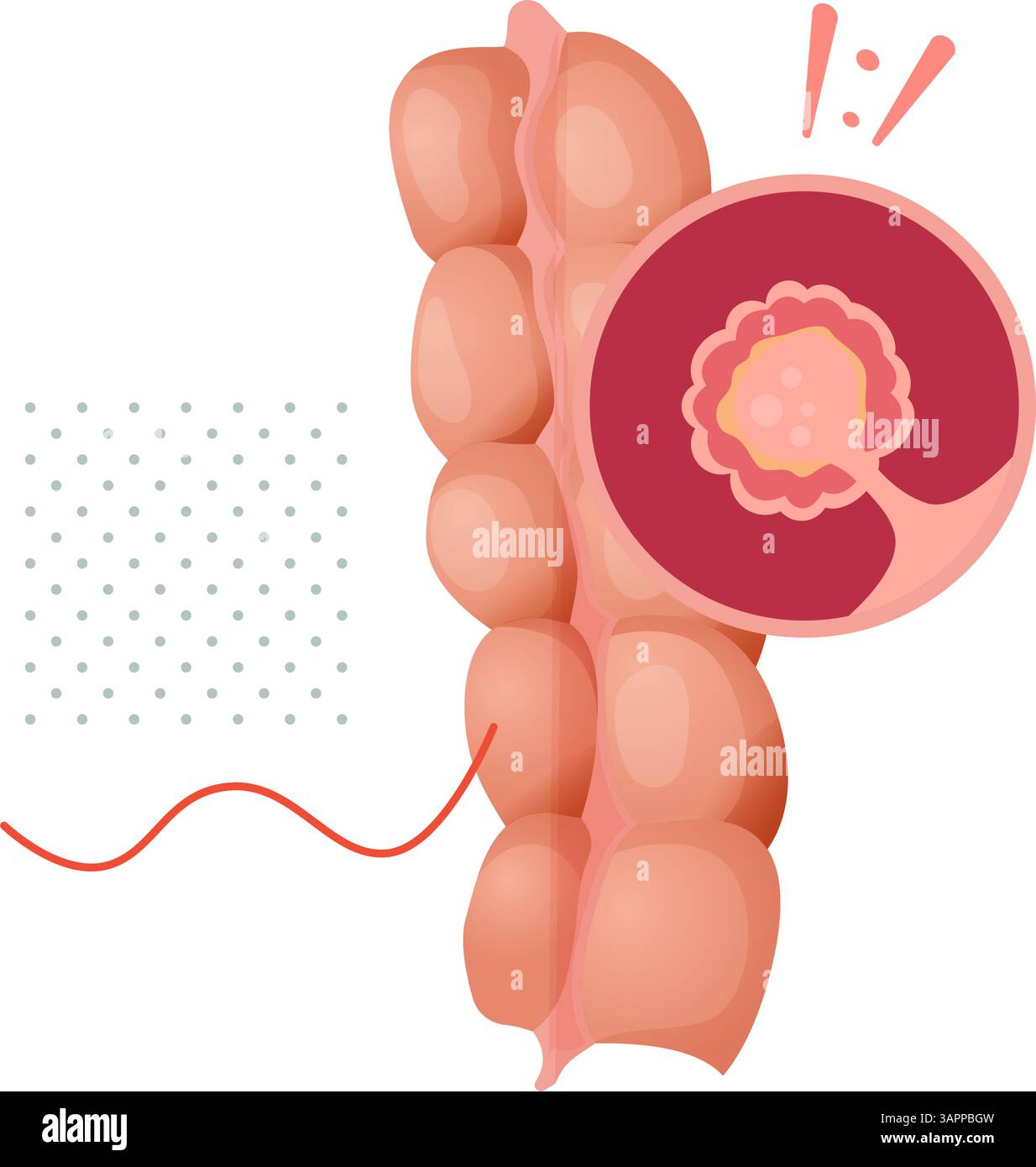 Polipi del colon - una crescita anomala del tessuto - illustrazioni di scorta come file EPS 10 Illustrazione Vettoriale