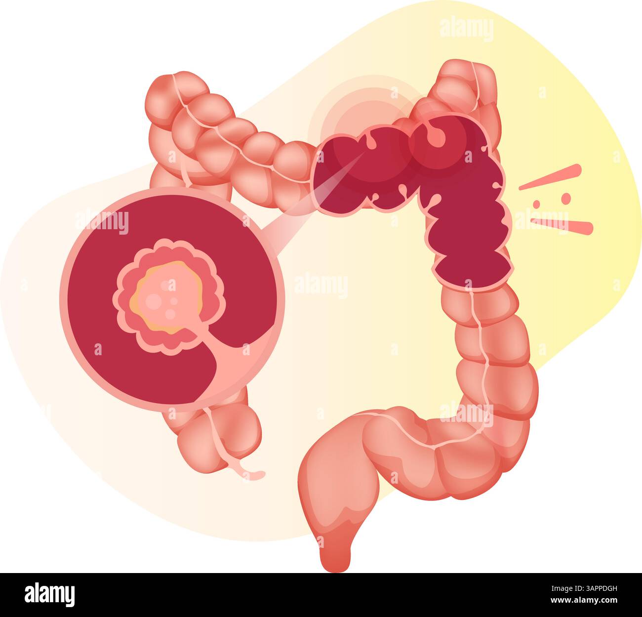 Polipi del colon - una crescita anomala del tessuto - illustrazioni di scorta come file EPS 10 Illustrazione Vettoriale