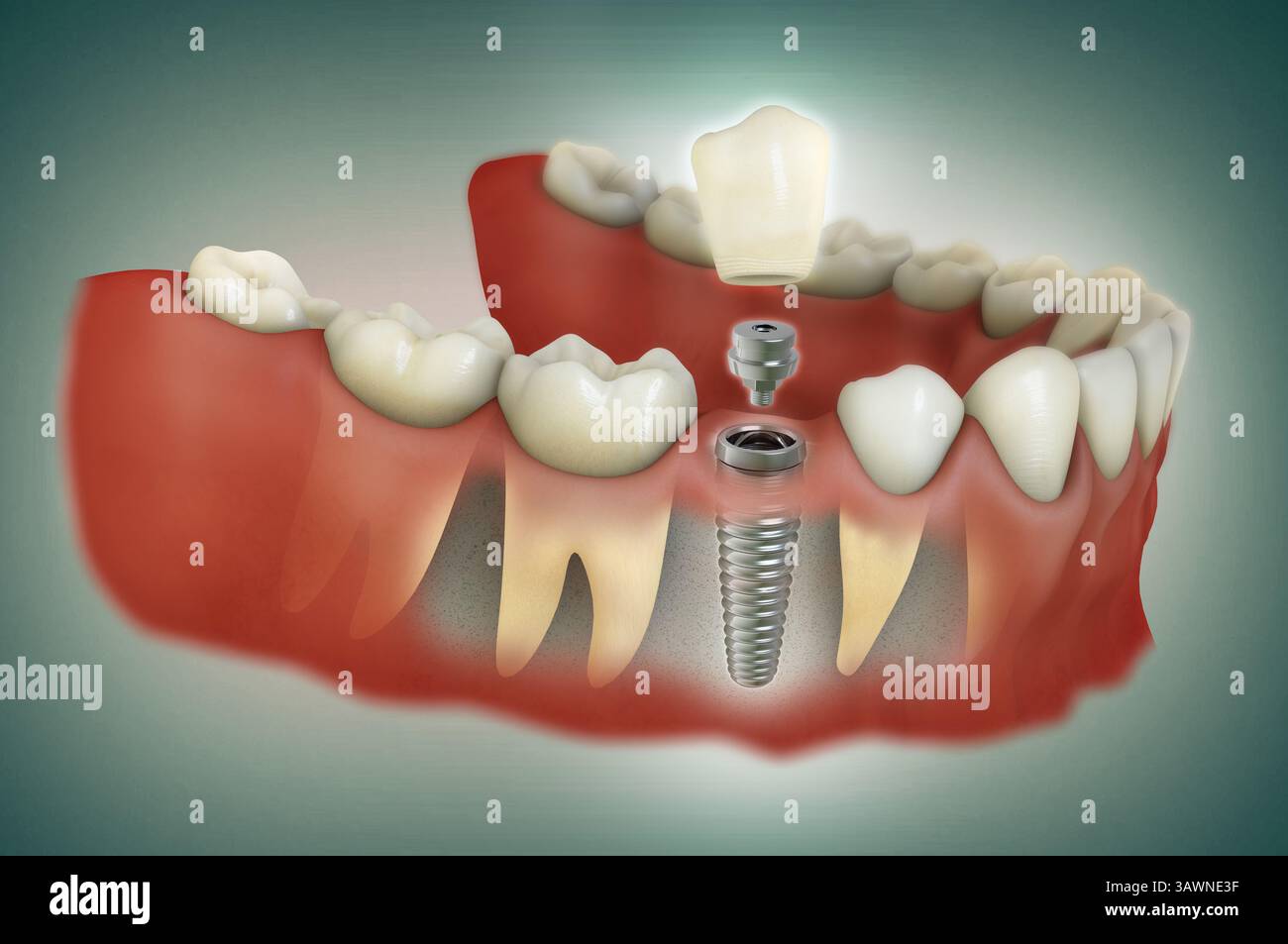 L'illustrazione in 3D di un impianto dentale a dente singolo mostra separatamente ogni componente della procedura (impianto, abutment e corona). Foto Stock