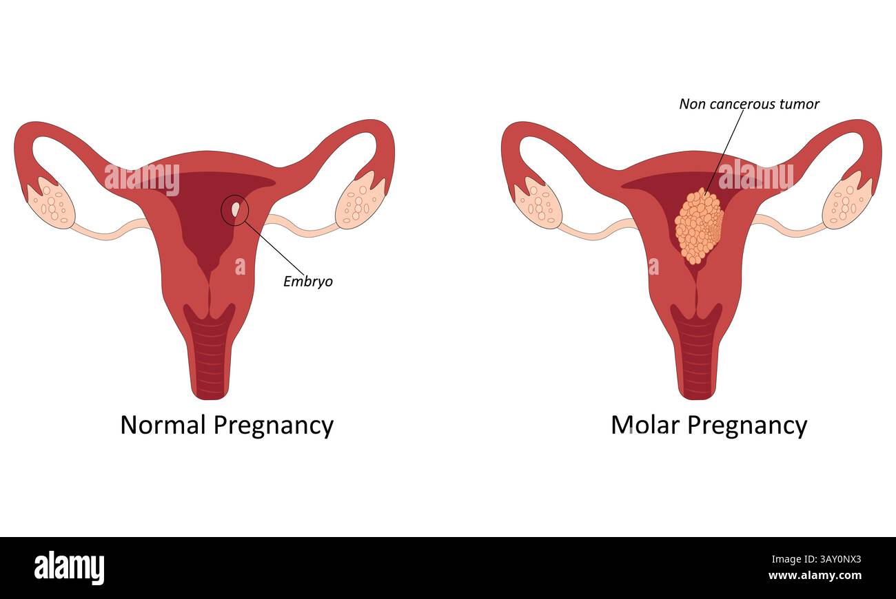 Gravidanza molare nell'illustrazione vettoriale dell'utero Illustrazione Vettoriale