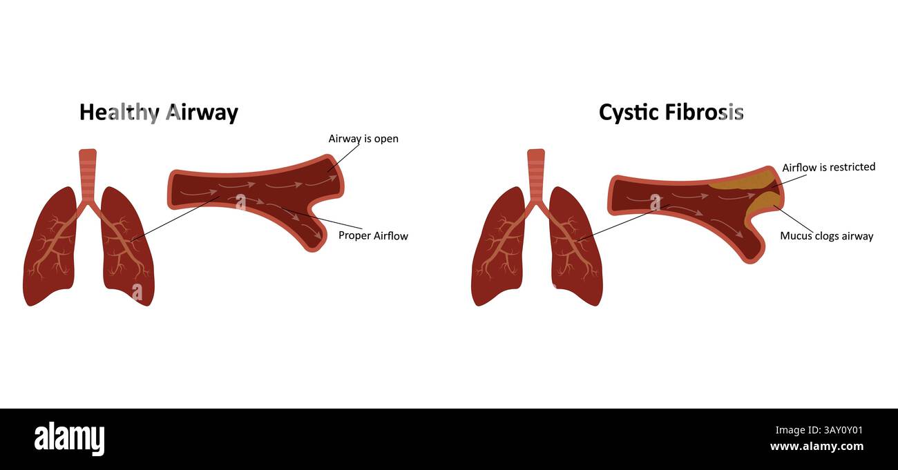 Illustrazione vettoriale della fibrosi cistica nei polmoni Illustrazione Vettoriale