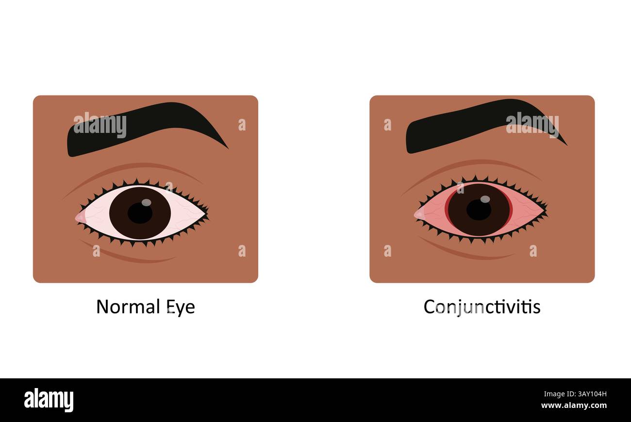 Illustrazione vettoriale della congiuntivite della malattia dell'occhio Illustrazione Vettoriale
