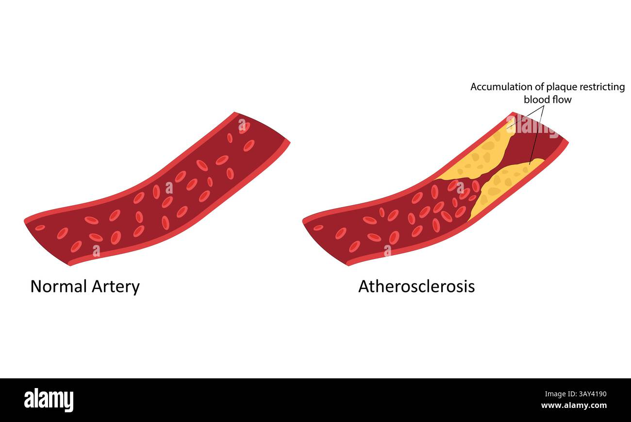 Aterosclerosi su illustrazione del vettore dell'arteria Illustrazione Vettoriale