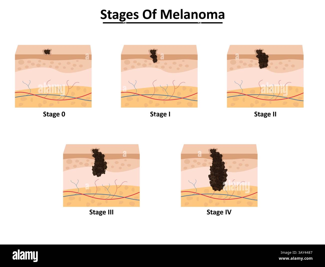 Fasi dell'illustrazione vettoriale del melanoma Illustrazione Vettoriale