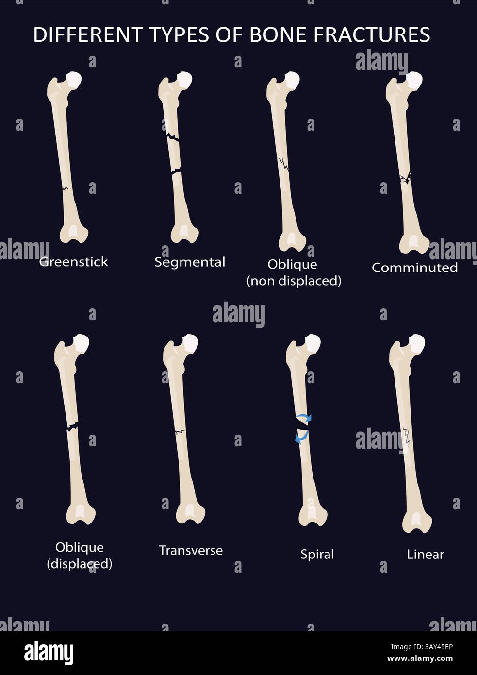 Tipi di fratture ossee infografica del vettore. comminato, verdastro, trasversale, obliquo Illustrazione Vettoriale