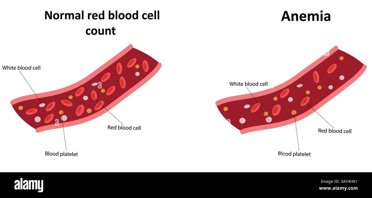 Illustrazione dell'anemia e del normale vettore della conta eritrocitaria Illustrazione Vettoriale