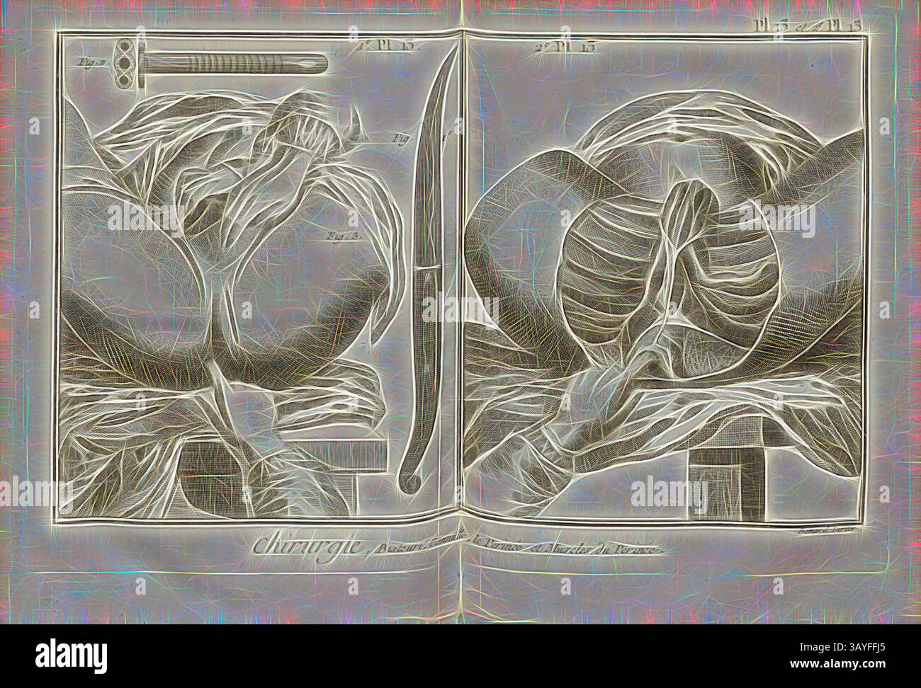 Un'illustrazione complessa che raffigura uno studio anatomico dettagliato, che mostra il corpo umano e gli strumenti chirurgici. L'opera enfatizza la complessità dell'anatomia umana, evidenziando strutture muscolari e tecniche chirurgiche, ambientate in uno sfondo che ne esalta il significato storico., Surgery 12, perineo e addome mostrato dopo il metodo di M. Foubert, firmato: Benard direx, PL. 13 e 2. PL. 13, dopo P. 48, Benard (dir.), 1778, Denis Diderot; m. d'Alembert: Encyclopédie, ou Dictionnaire raisonné des Sciences, des Arts et des métierss, des Arts et des métiers. Genève: chez pellet Foto Stock
