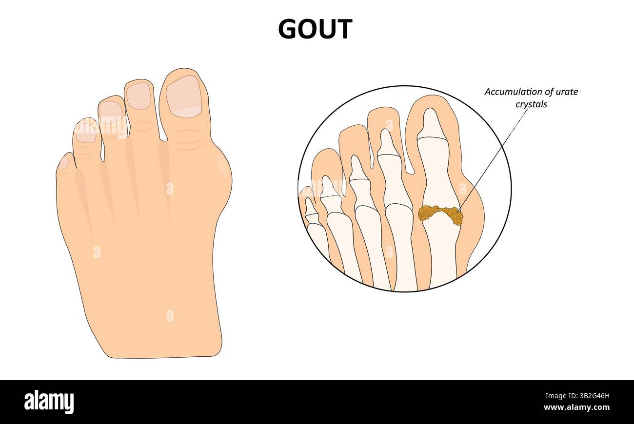 Illustrazione vettoriale della malattia del piede della gotta Illustrazione Vettoriale