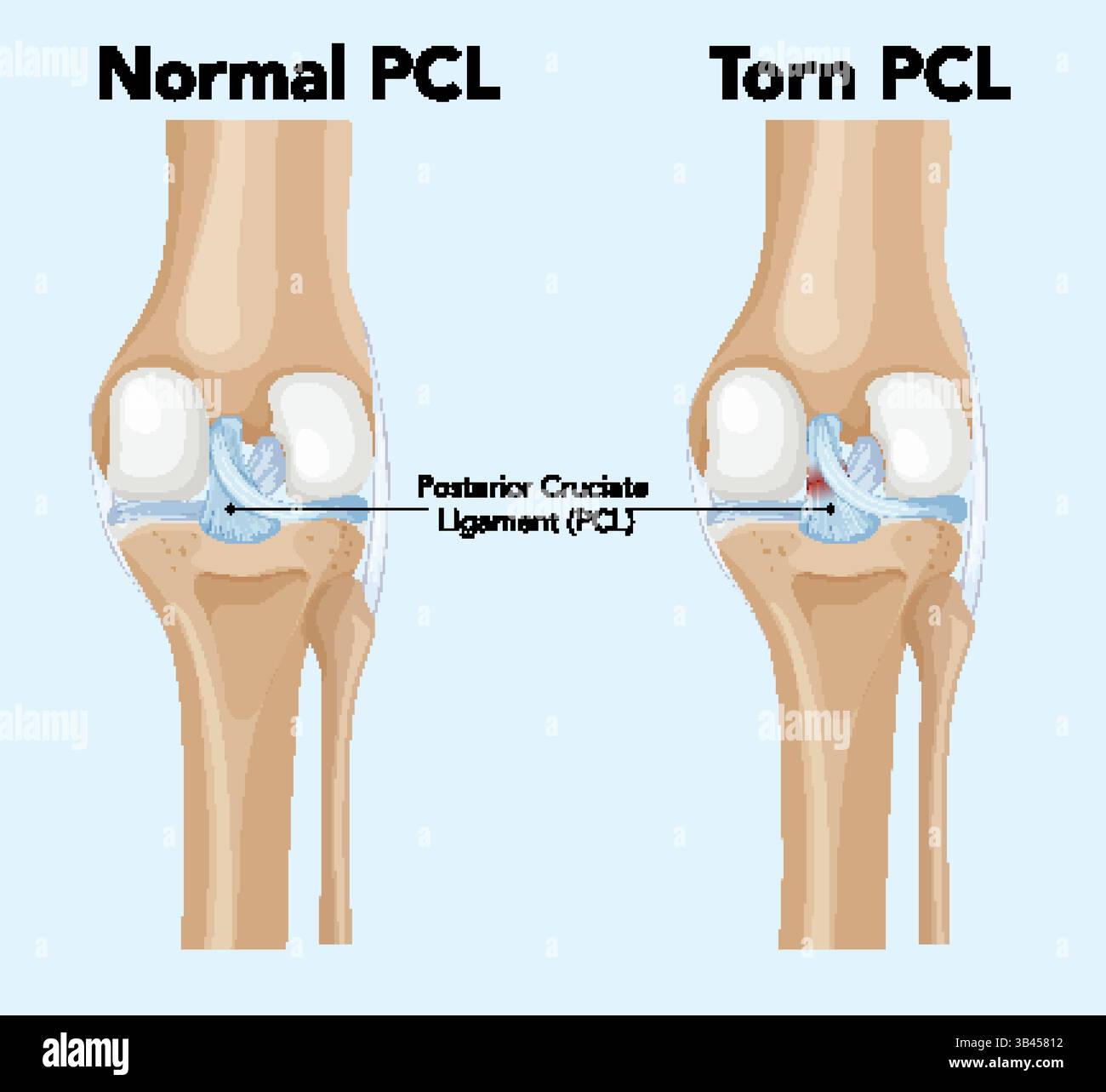Illustrazione dell'articolazione del ginocchio che evidenzia le differenze tra il legamento crociato posteriore normale e lacerato. Stile del vettore anatomico dettagliato Illustrazione Vettoriale