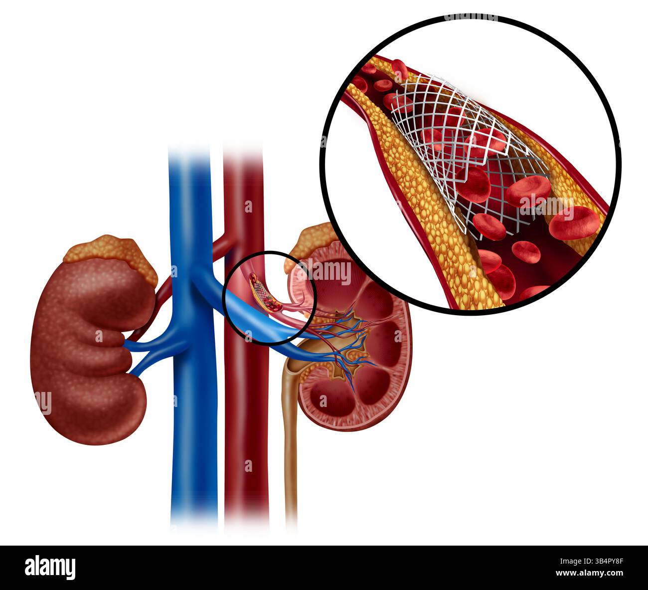 Angioplastica renale e stent come impianto di stent renali umani con arterie bloccate come illustrazione medica dell'anatomia interna del sistema urinario Foto Stock