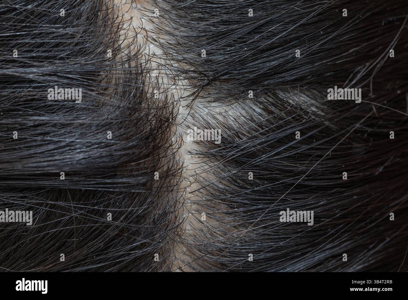 Cuoio capelluto con capelli neri che mostrano segni di forfora e dermatite seborroica, una condizione comune della pelle Foto Stock