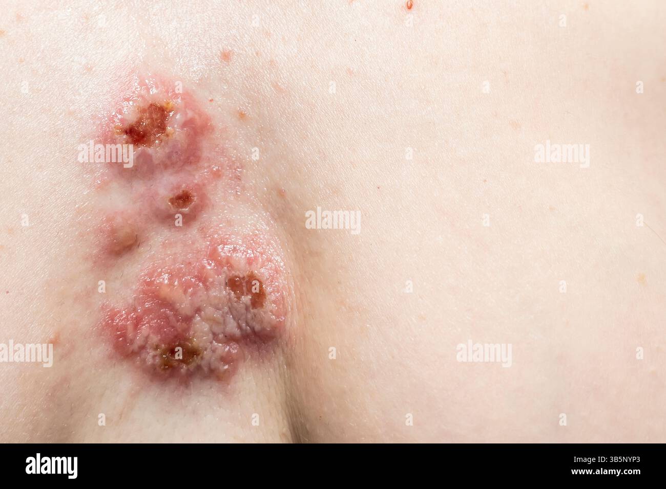 Le ferite sulla pelle nella zona toracica. Pioderma sul corpo della donna. Complicazioni della malattia con l'infezione batterica sulla pelle Foto Stock