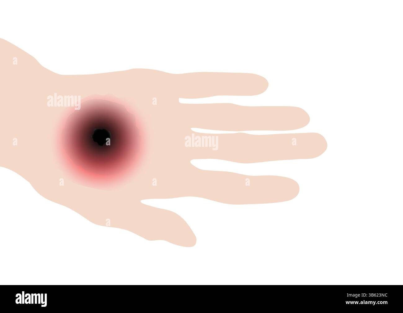 Escar, mano con lesione cutanea rossa di antrace con centro scuro Illustrazione Vettoriale