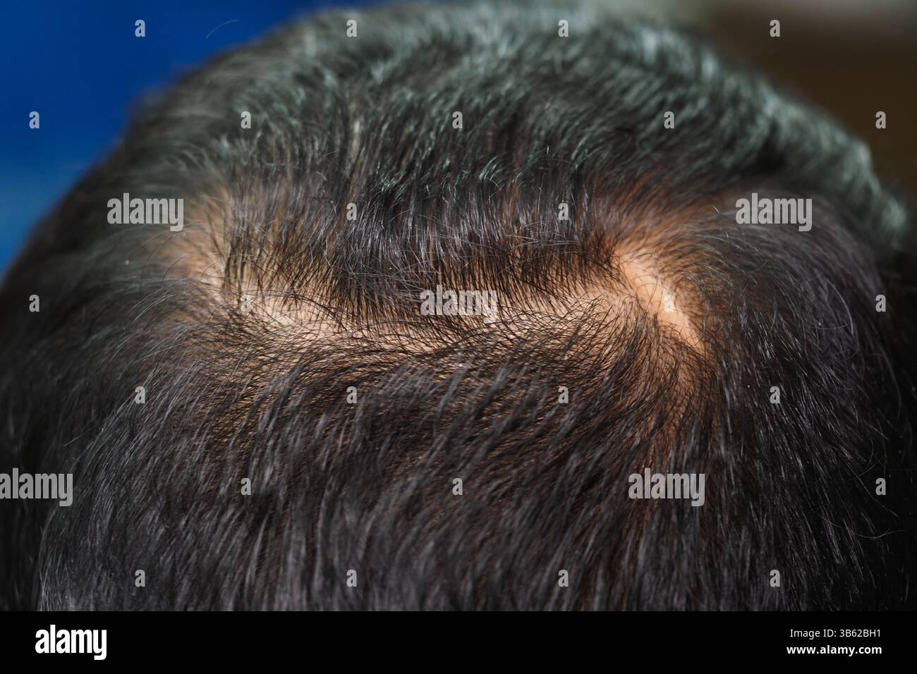 Punto calvo sulla testa che mostra capelli sottili e cuoio capelluto leggero Foto Stock