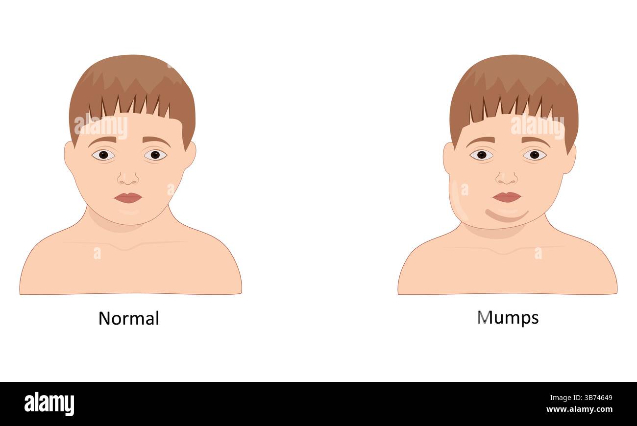 Illustrazione del vettore parotite Illustrazione Vettoriale
