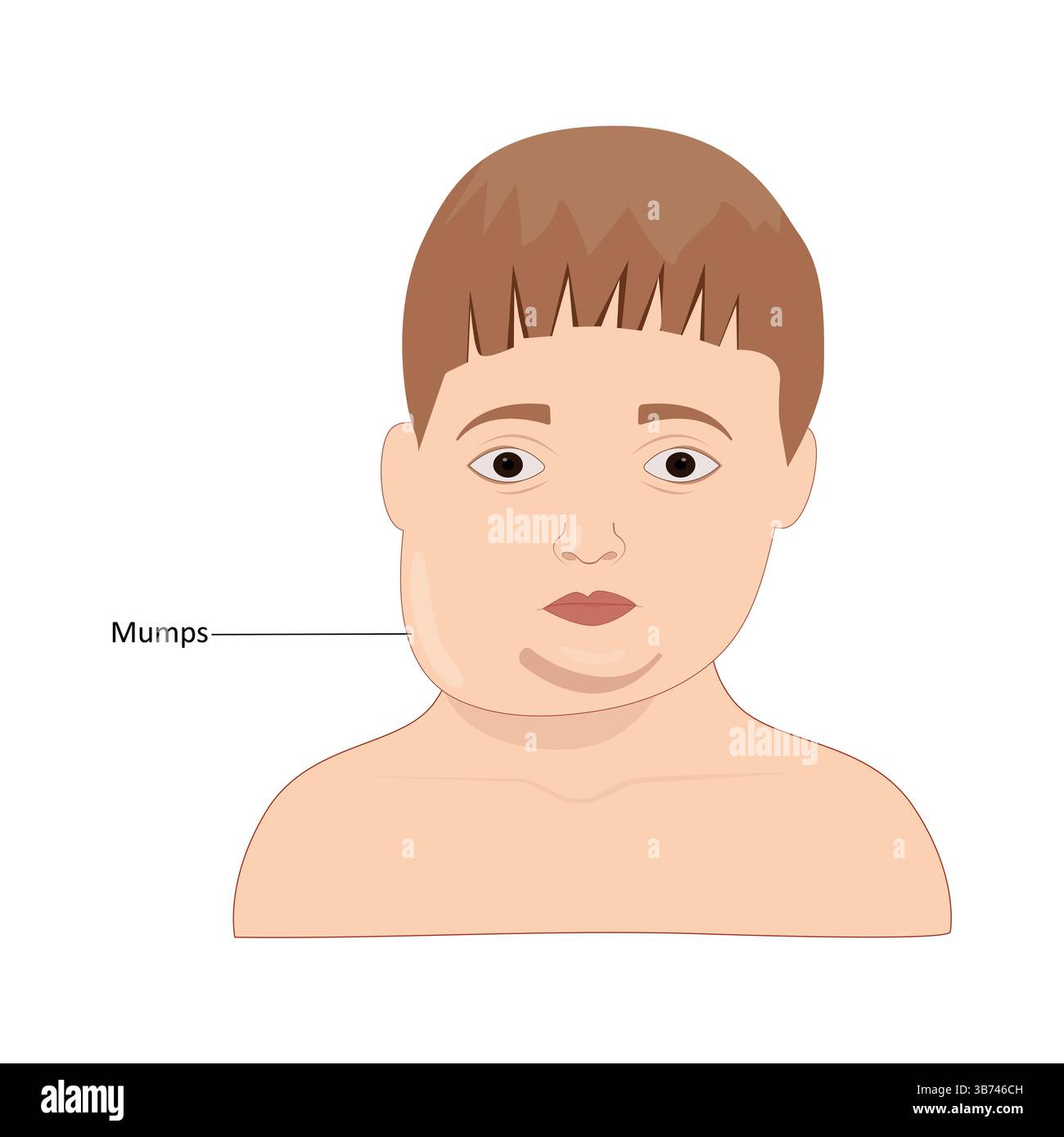 Illustrazione del vettore parotite Illustrazione Vettoriale